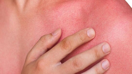 Fucidin, yanıkların tedavisinde kullanılan etkili bir antibiyotik ilaçtır. Fucidin'in...