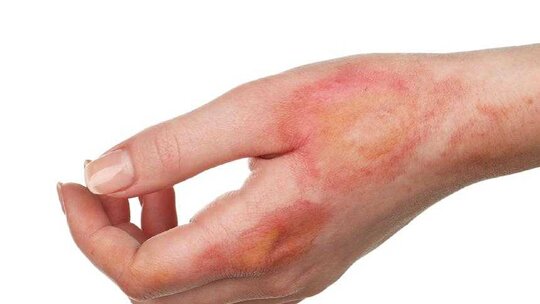 Hametan krem, yanık tedavisinde kullanılan doğal bir ilaçtır ve ciltteki yaraların...