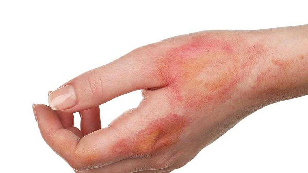 Hametan Krem: Yanık Tedavisinde Doğal Yardımcınız