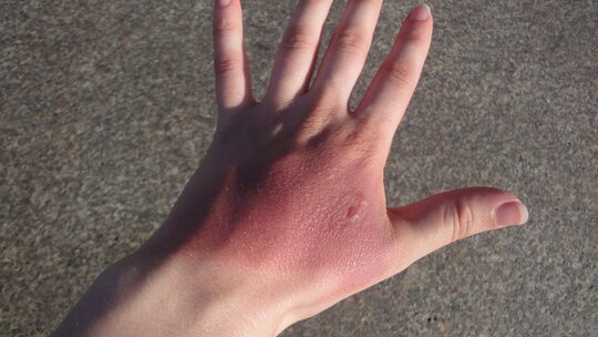 Burnazin, yanık yaralarında hızlı iyileşme ve enfeksiyon önleme konusunda etkili...