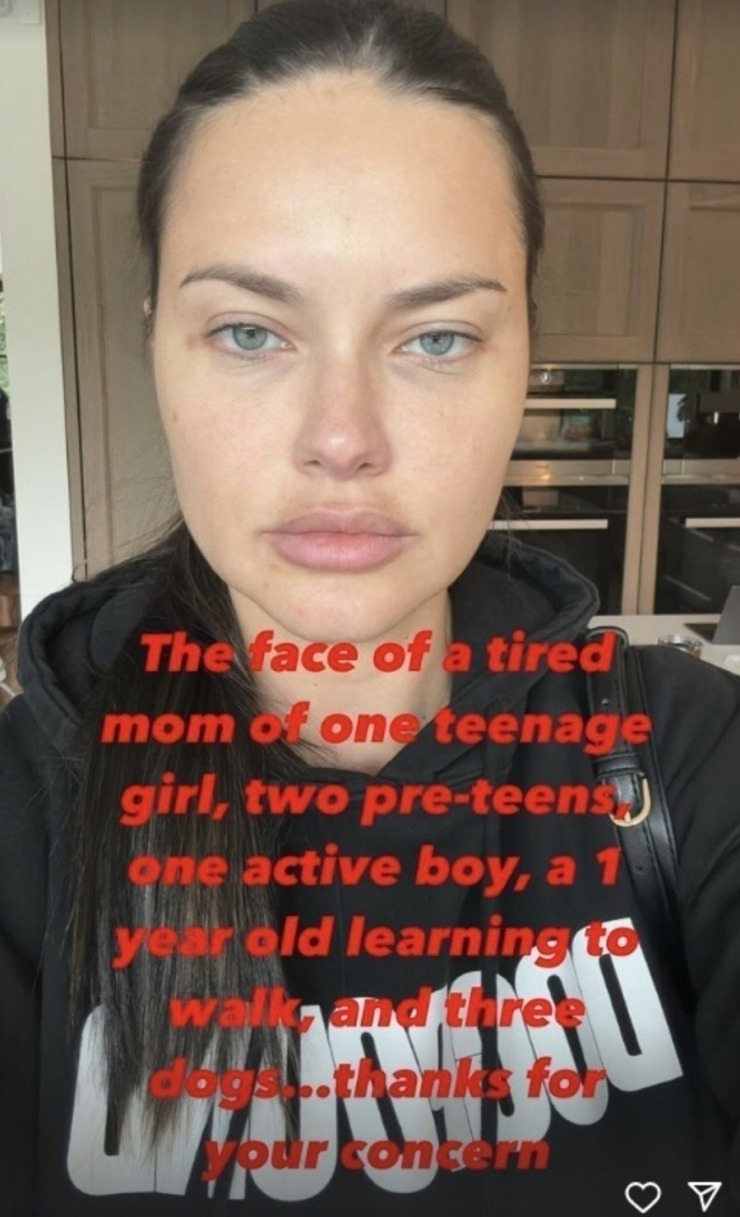 Adriana Lima, Estetik İddialarına Sessizliğini Bozdu!