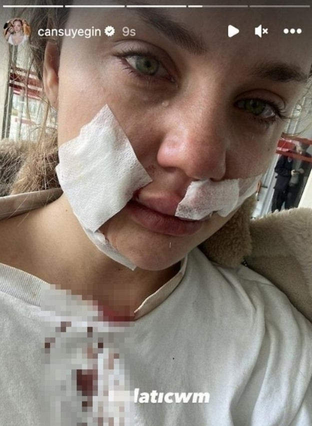 Fenomen Cansu Yeğin, Köpeği Tarafından Saldırıya Uğradı! Yüzünü Isırdı...