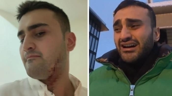 Czn Burak'ın Yüzüne Ne Oldu? Suratı Paramparça...