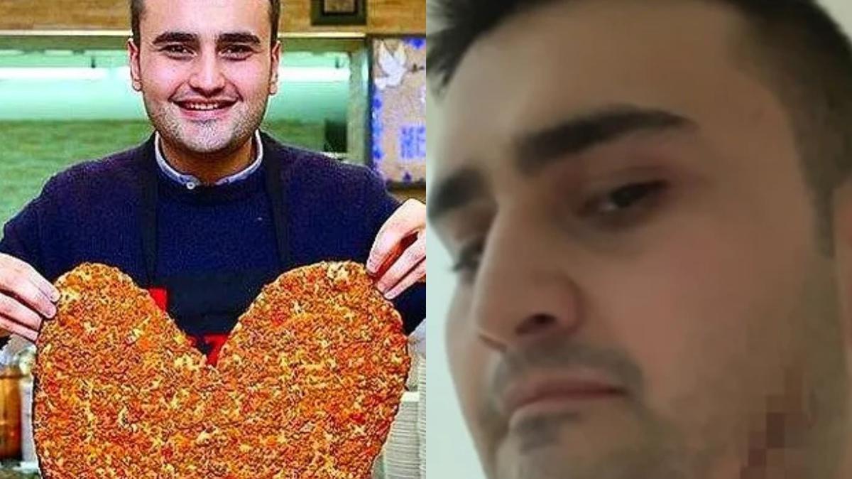 Czn Burak'ın Yüzüne Ne Oldu? Suratı Paramparça...