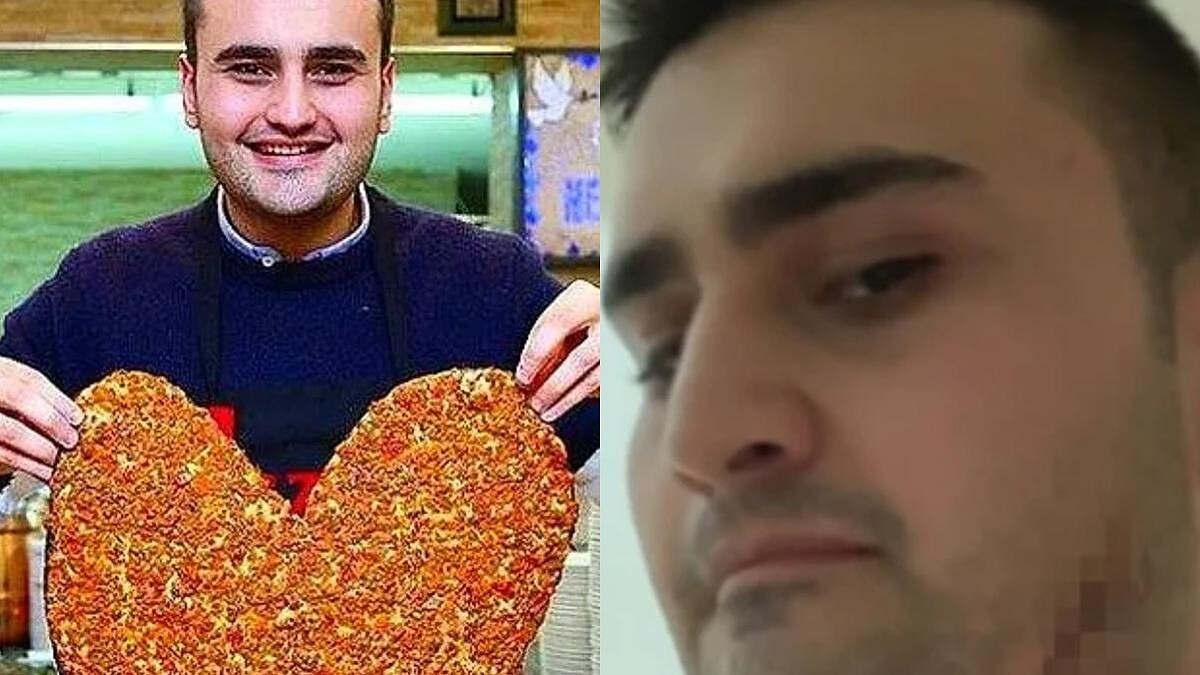 Czn Burak'ın Yüzüne Ne Oldu? Suratı Paramparça...