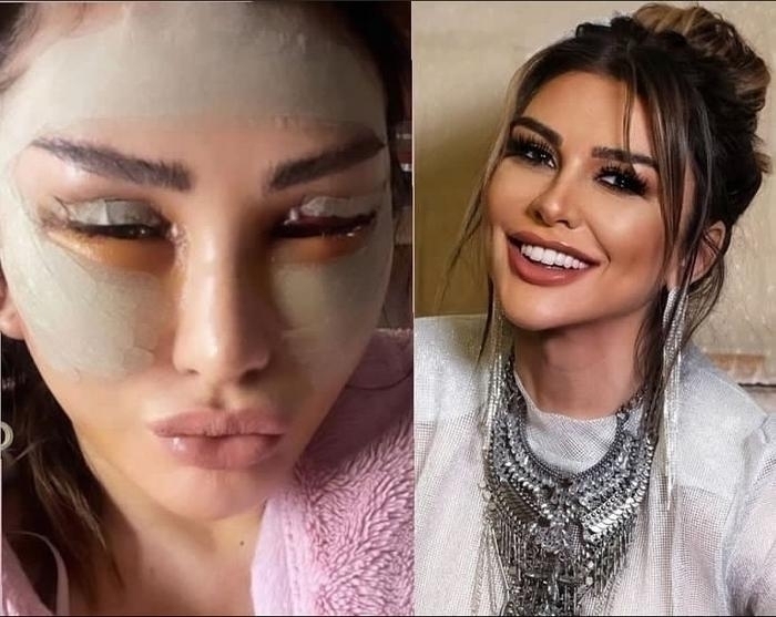 Selen Görgüzel Estetik Operasyon Sonrası Morarmış Yüzünü Paylaştı