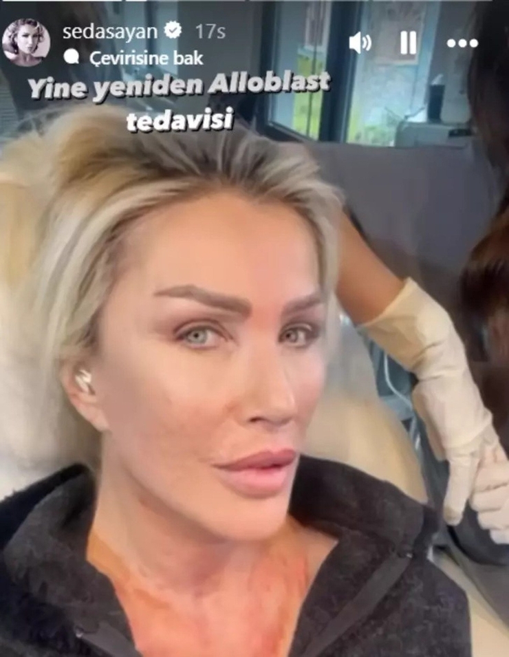 Seda Sayan'ın Genç Kalmak İçin Yaptığı Estetik Operasyonlar Şaşırttı
