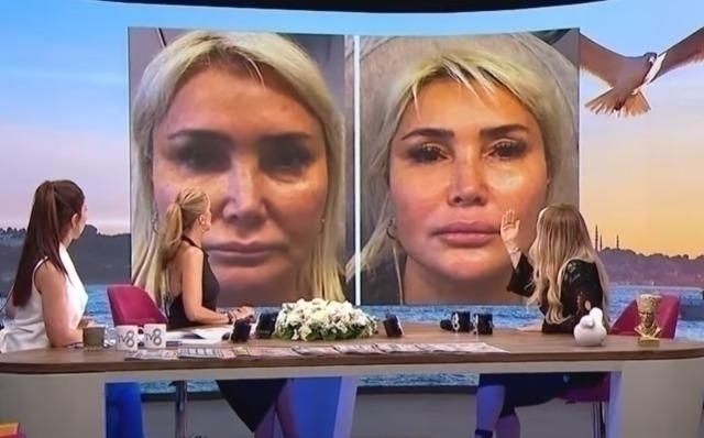 Yonca Evcimik Estetik Operasyonlarını Açıkladı: Müge Dağıstanlı'nın Sözleri Olay Yarattı