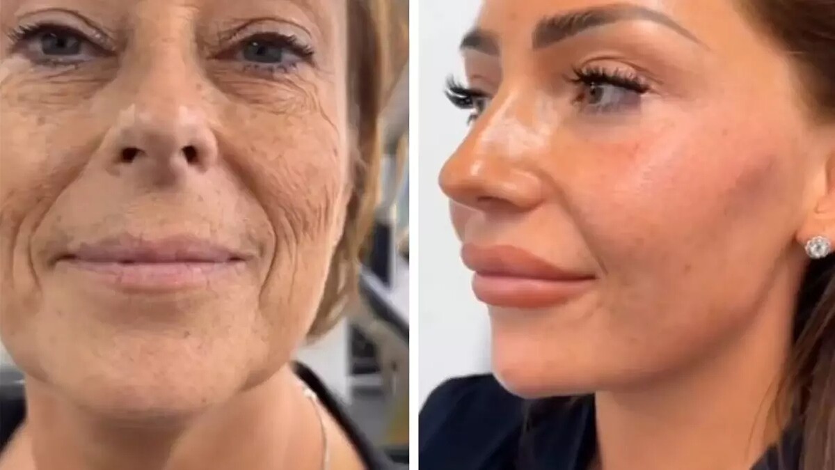 Kadın Yüz Gerdirme Ameliyatıyla 30 Yaş Gençleşti, İzleyenler Şaşkınlığını Gizleyemedi