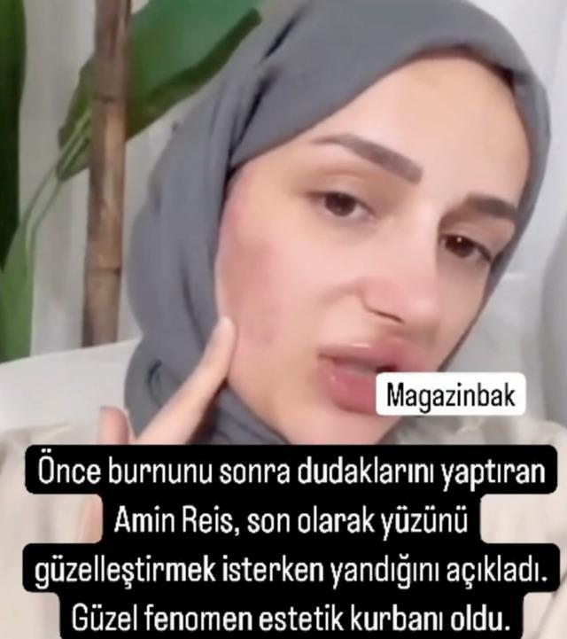Gizem Yıldız'ın estetik macerası kabusa döndü, cildi güzellik merkezinde yandı
