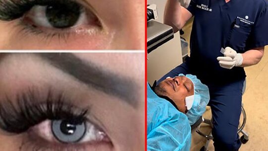 Göz rengini değiştiren cerrahi işlem popüler hale geldi. Dr. Wachler, hastalarının...