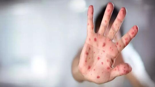 ABD'de kızamık salgını alarmı! Vaka sayısı 48'e yükseldi...