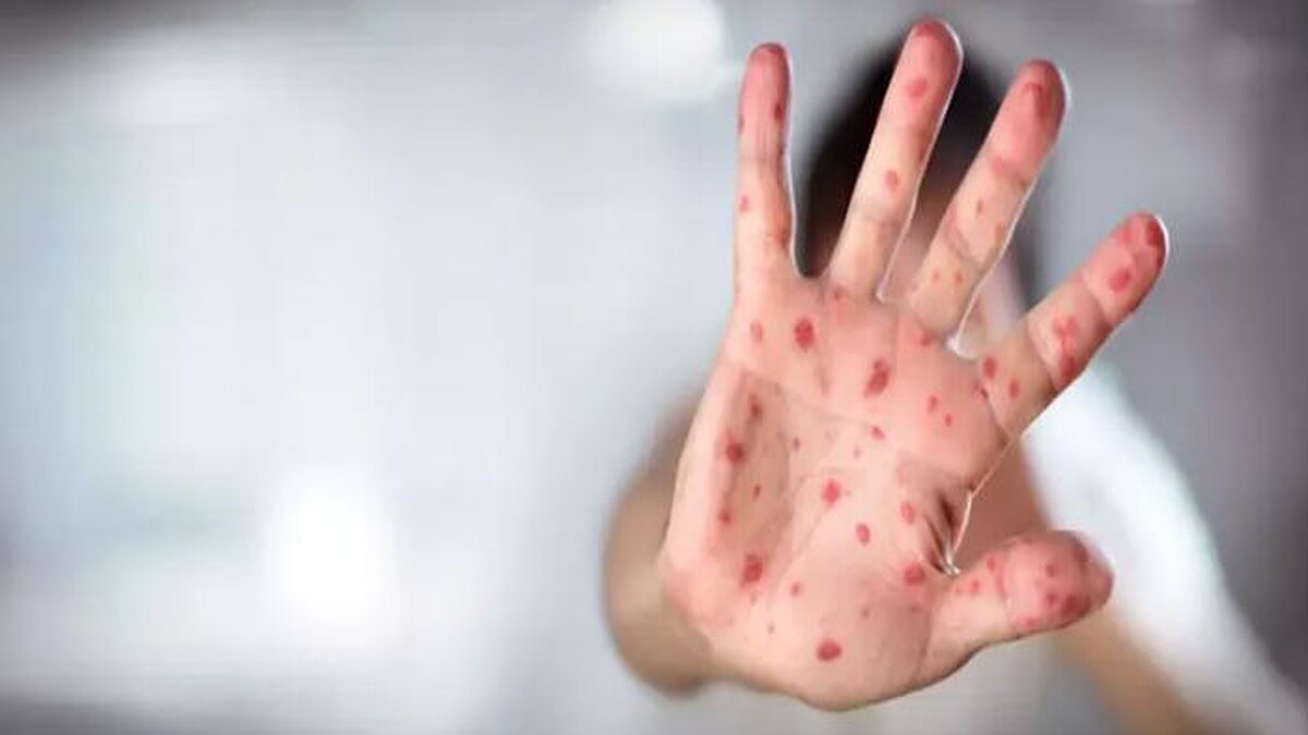 ABD'de kızamık salgını alarmı! Vaka sayısı 48'e yükseldi...