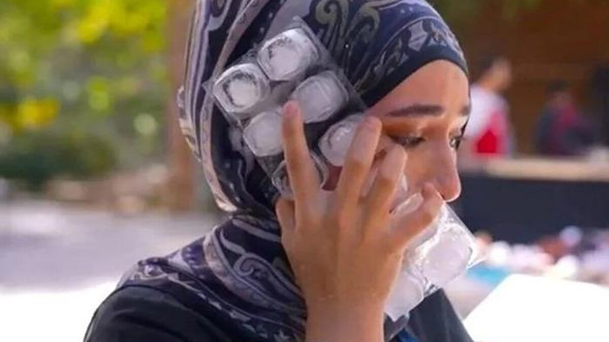 Beyza Aydın, yüzünün yanık halini paylaştı!