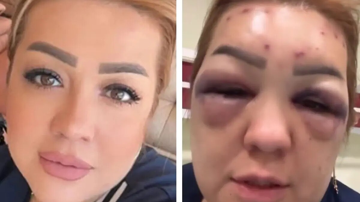 Kahramanmaraş'ta botoks kabusu: Yüzü şişen kadın hastanelik oldu