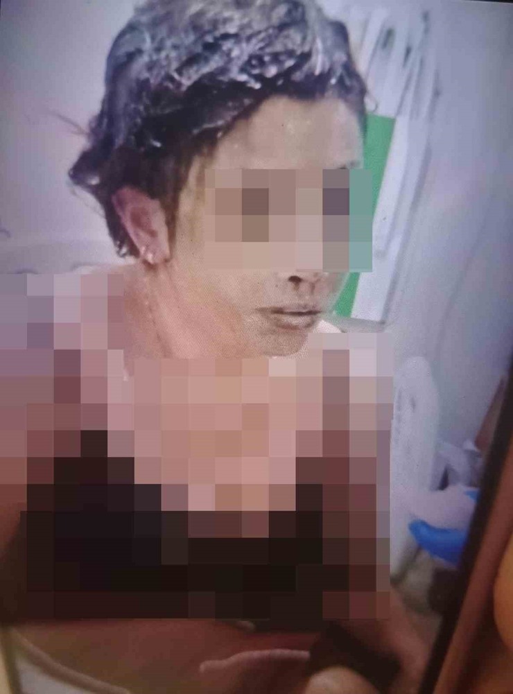 Gaziantep'te Vahşet: Boşandığı Eşini Bağlayıp Kezzap Döktü