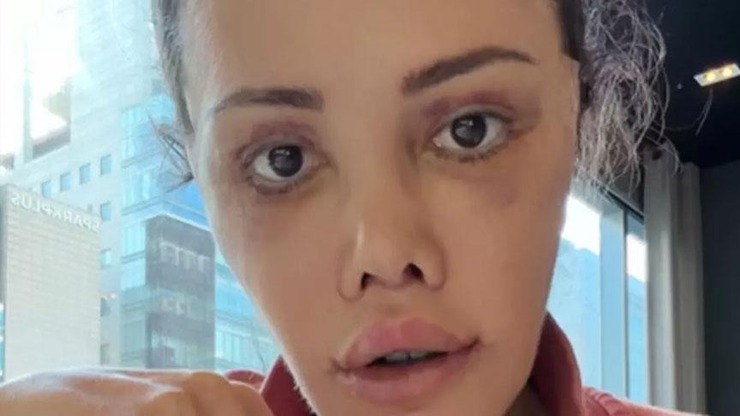 Survivor Didem Yüz Nakli Sonrası Son Halini Paylaştı