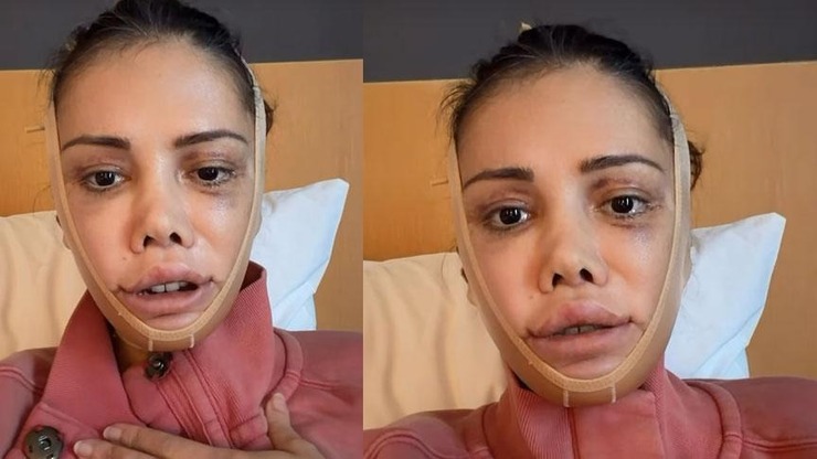 Survivor Didem Yüz Nakli Sonrası Son Halini Paylaştı