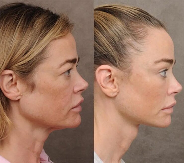 Denise Richards Estetik Operasyonlarını Cerrahıyla Birlikte Duyurdu