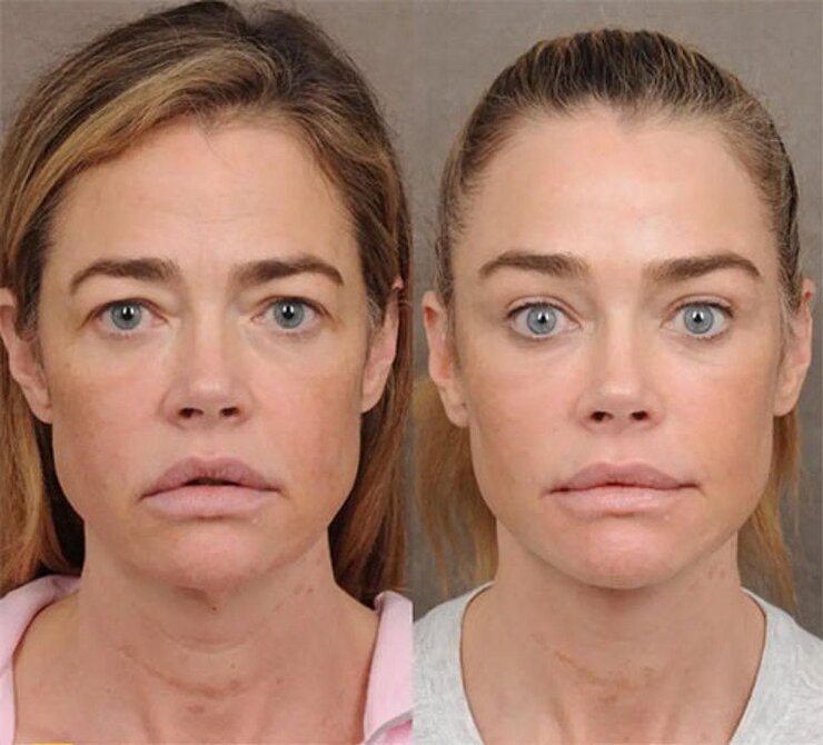 Denise Richards Estetik Operasyonlarını Cerrahıyla Birlikte Duyurdu