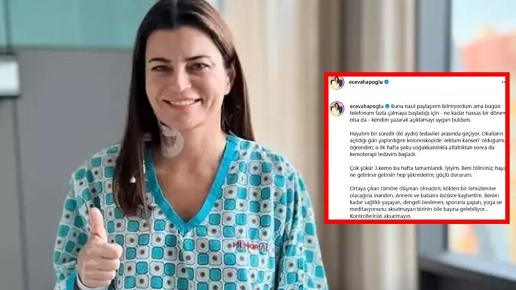 Ece Vahapoğlu Rektum Kanseri Tedavisinde Son Aşamaya Geldi