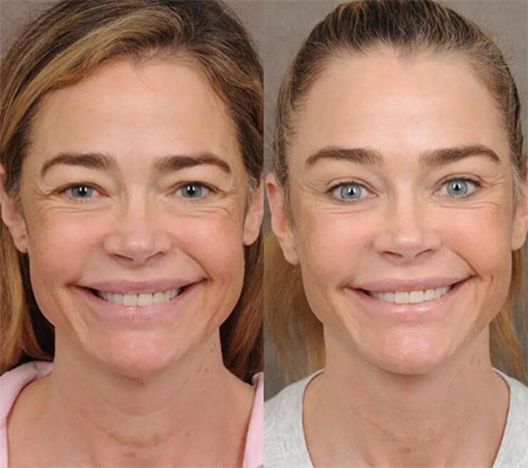 Denise Richards Estetik Operasyonlarını Cerrahıyla Birlikte Duyurdu