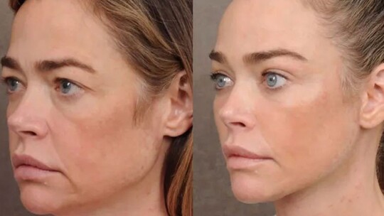 Denise Richards, yüzüne yaptırdığı estetik müdahaleleri gizlemek yerine estetik...