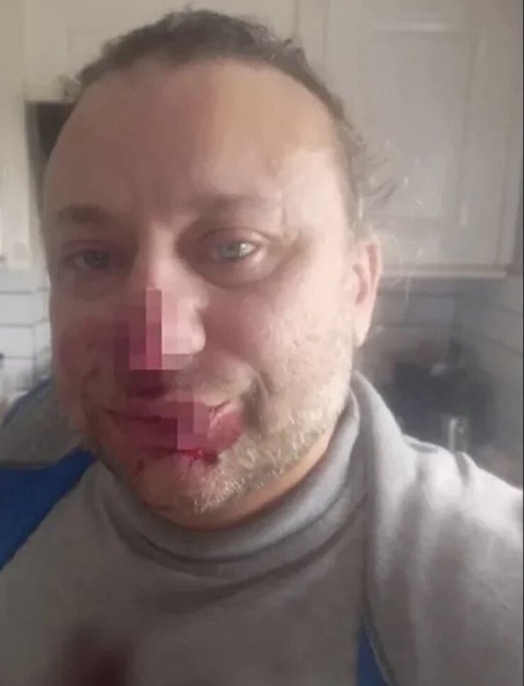 Onur Akay Pitbull Saldırısından Sonra Ölümden Döndüğünü Anlattı