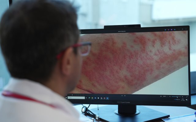 Egzamalı Çocuklarda Gereksiz Diyet Alerji Riskini Artırıyor