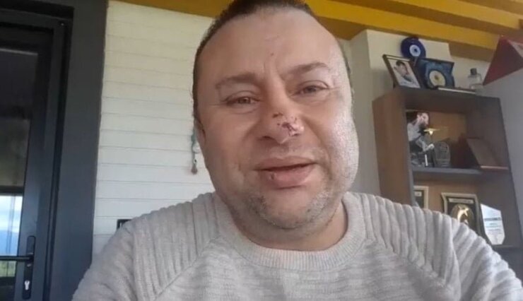 Onur Akay Pitbull Saldırısından Sonra Ölümden Döndüğünü Anlattı