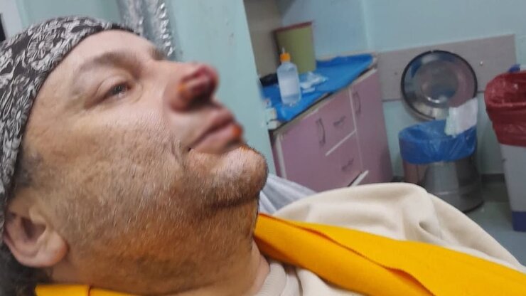 Onur Akay Pitbull Saldırısında Burnundan Parça Kaybetti