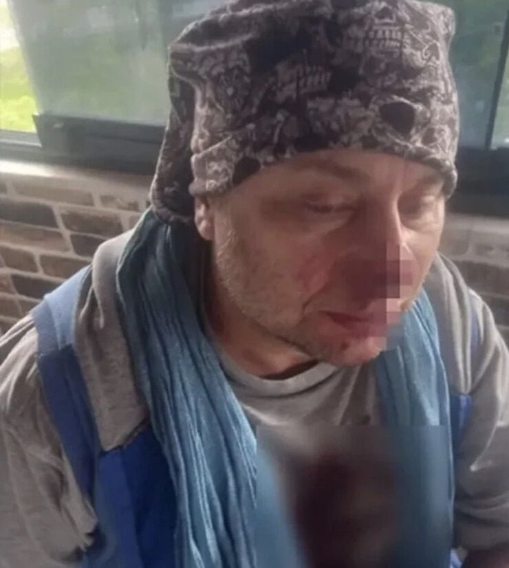 Onur Akay Pitbull Saldırısından Sonra Ölümden Döndüğünü Anlattı