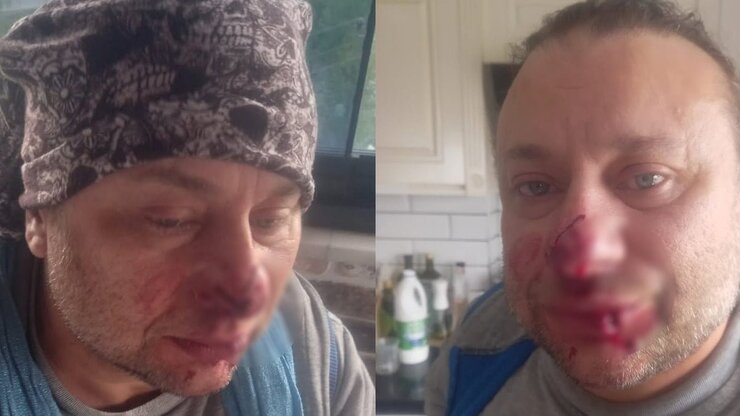 Onur Akay Pitbull Saldırısında Burnundan Parça Kaybetti