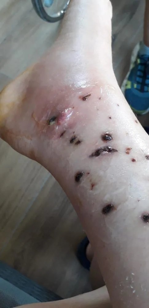 İzmir'de Köpek Saldırısına Uğrayan Emekli Polis Suç Duyurusunda Bulundu