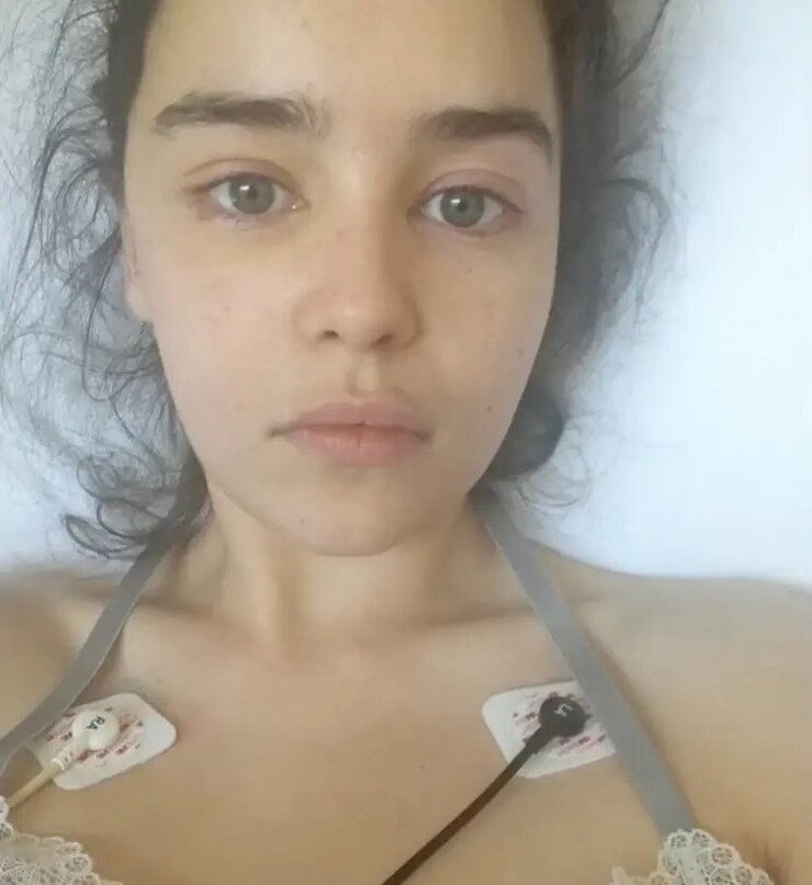 Emilia Clarke Oynarken İki Kez Beyin Kanaması Geçirdi