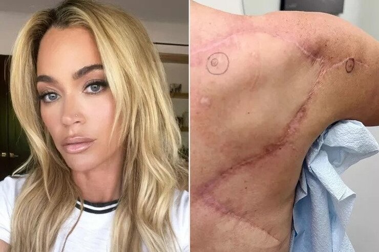 Teddi Mellencamp Ameliyat İzlerini Paylaşarak Kanser Yolculuğunu Anlattı