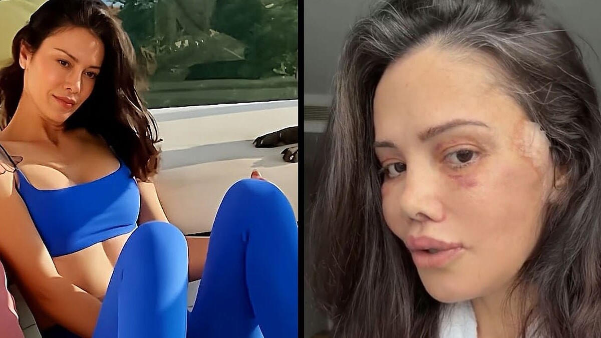 Survivor Yıldızı Didem Ceran Kore Estetiği Sonrası Yeni Halini Paylaştı